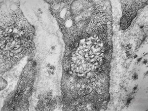 M, 3y. | lipofuscinosis